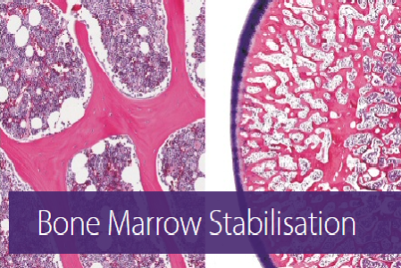 transfix-bone-marrow-stabilisation-47359726150dff5a